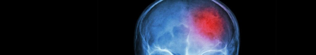 acquired brain injury claim