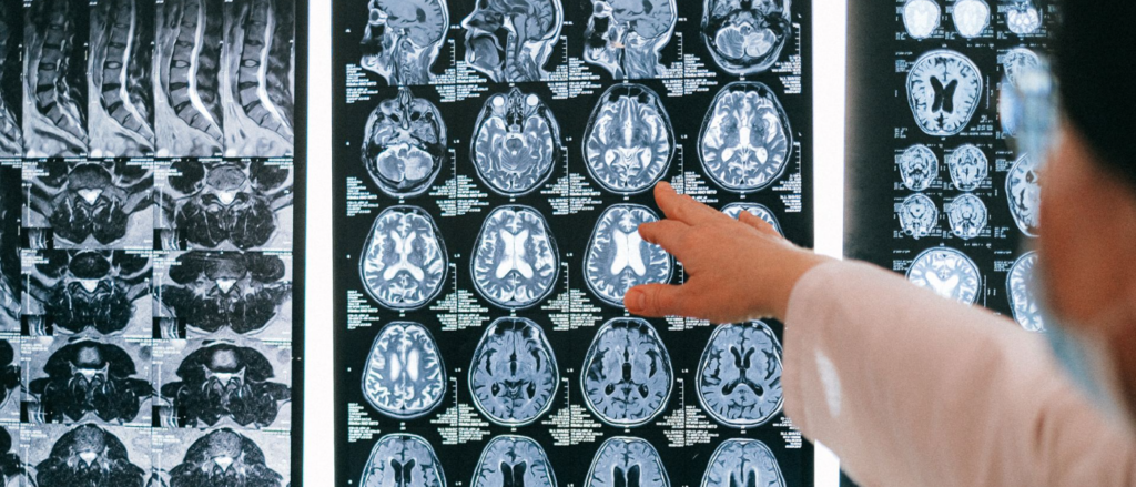 Catastrophic Brain Injury Solicitor