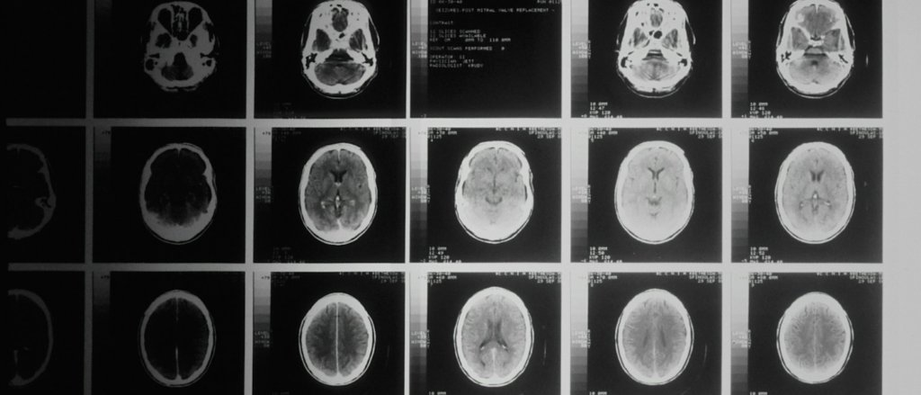 Traumatic Brain Injury Solicitor