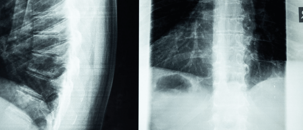 spinal injury solicitor